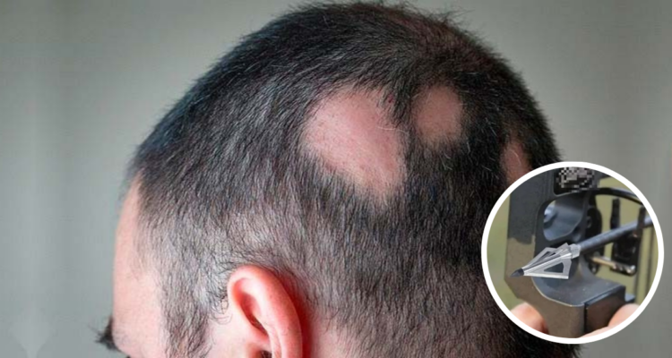 Hombre sobrevive a flecha en su cabeza