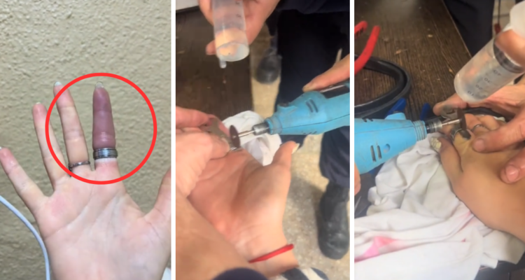 joven argentina es criticada tras casi perder su dedo por ajustado anillo