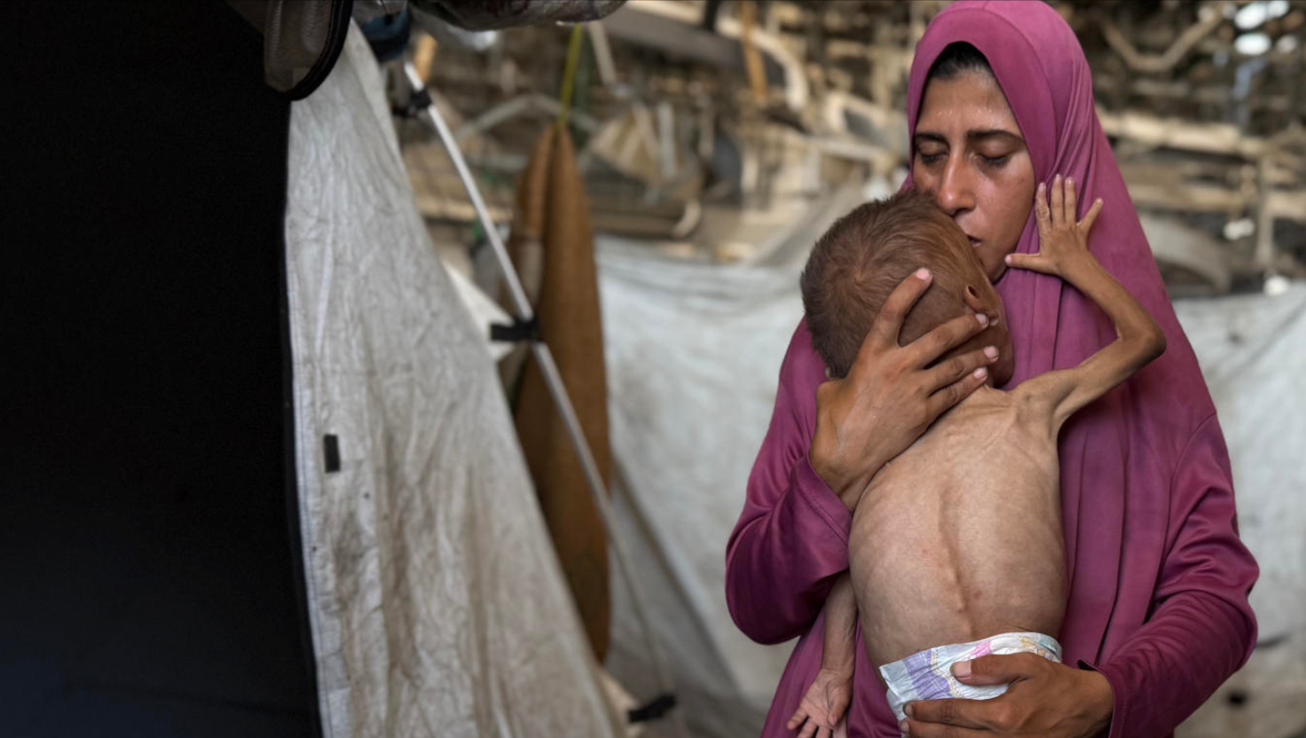 Niños en Gaza mueren por hambre y desnutrición