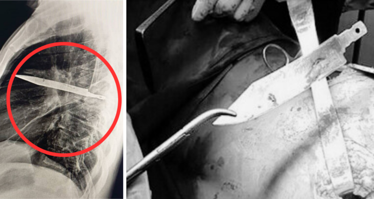 Tanzania: hombre fue al médico por pus que salía de su pecho y descubrió cuchillo enterrado hace años