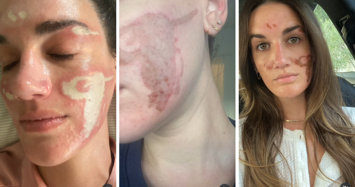 Mujer denuncia a cosmetóloga de celebridades por daños: "Pensé que era crema y era mi piel quemándose"