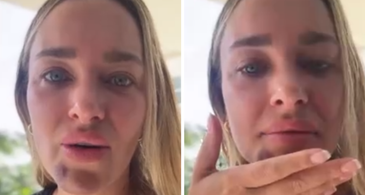 Daniela Nicolás terminó en urgencia tras sufrir fuerte caída en la ducha: “Fue un gran porrazo”