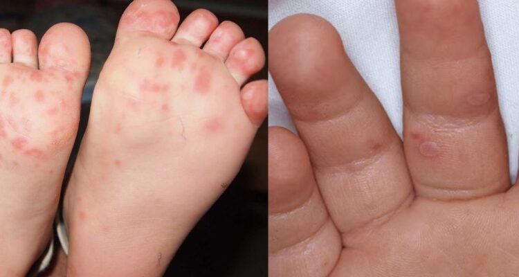 Qué es la enfermedad de boca, mano y pie: la infección que afecta a niños y va al alza en Atacama