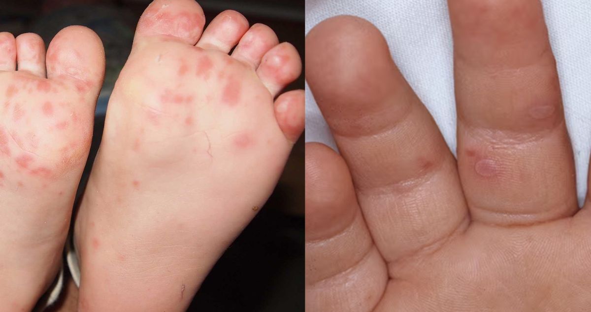Qué es la enfermedad de boca, mano y pie: la infección que afecta a niños y va al alza en Atacama