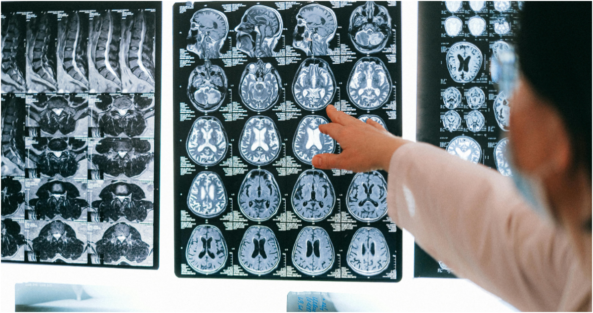 Foto de un escáner cerebral para ilustrar la enfermedad de Huntington