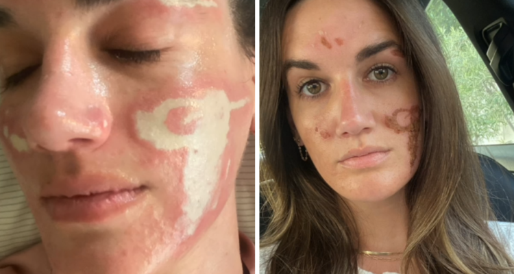 Mujer denuncia a esteticista de celebridades por daños: “Pensé que era crema y era mi piel quemándose”