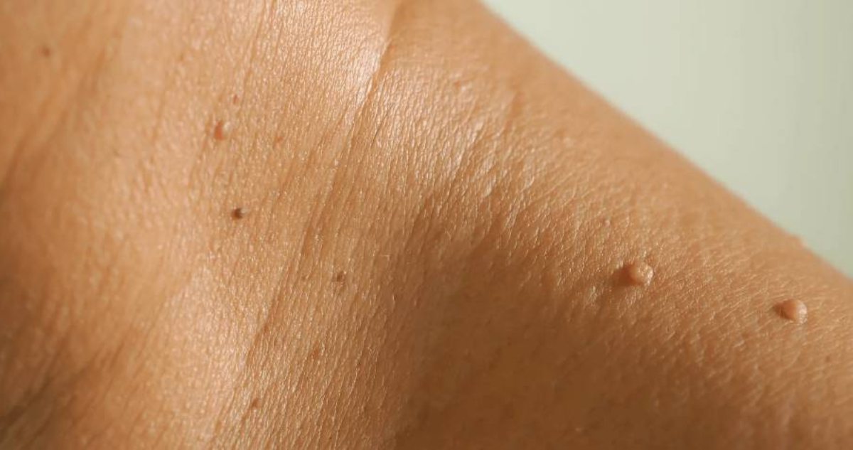 los lunares de carne en general son benignos, pero pueden indicar otros problemas de salud.