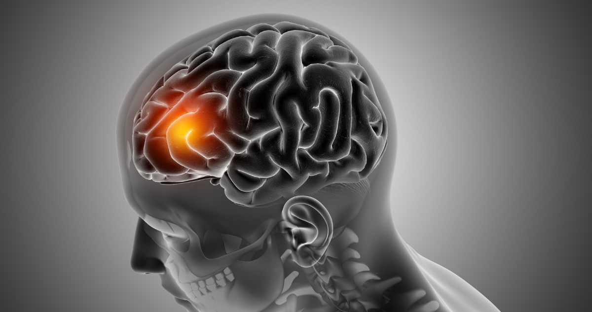 Cómo identificar si una persona está teniendo un ACV: actuar rápido es clave para tratarlo