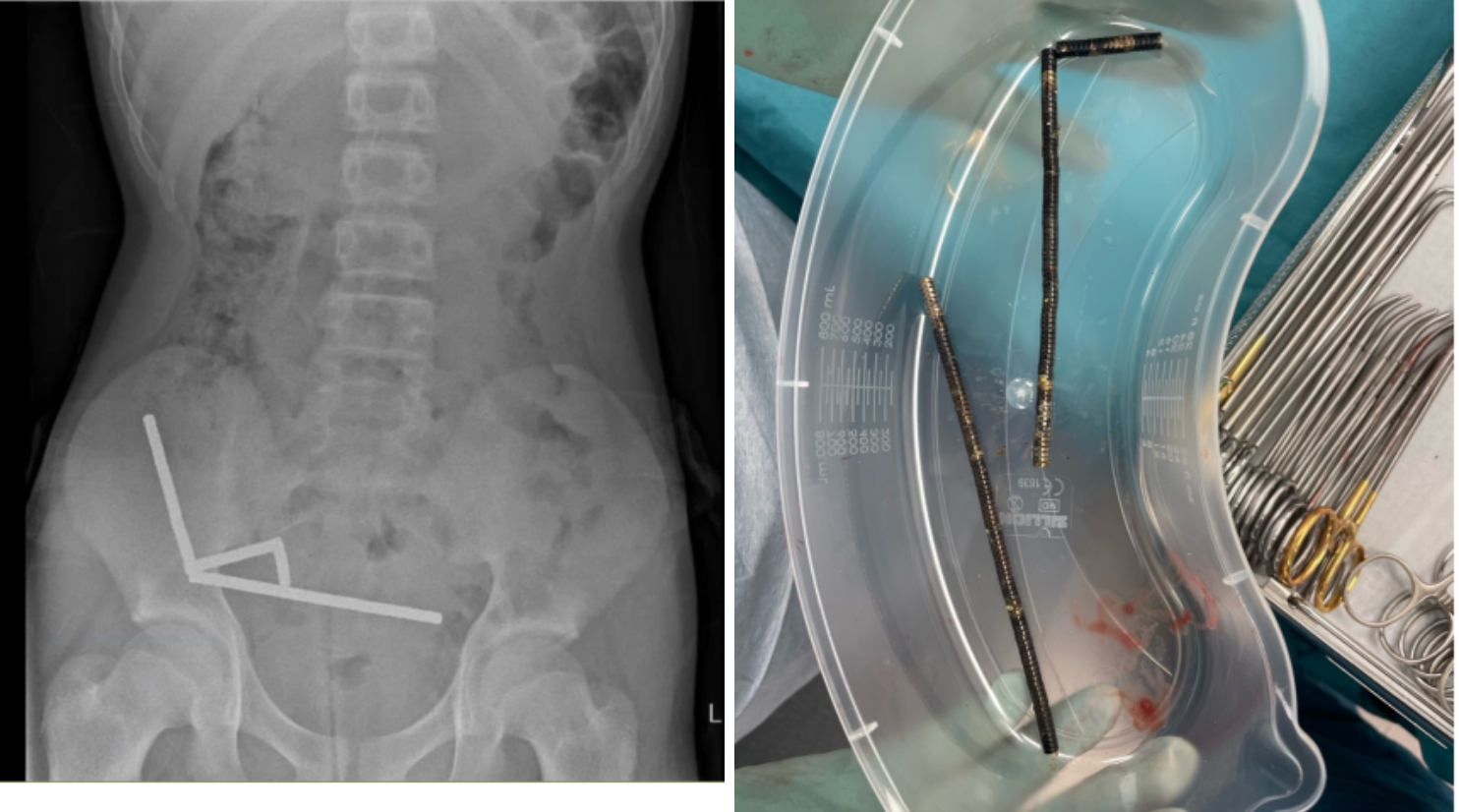 Niño termina con parte de sus intestinos extirpados por tragarse cerca de 100 imanes