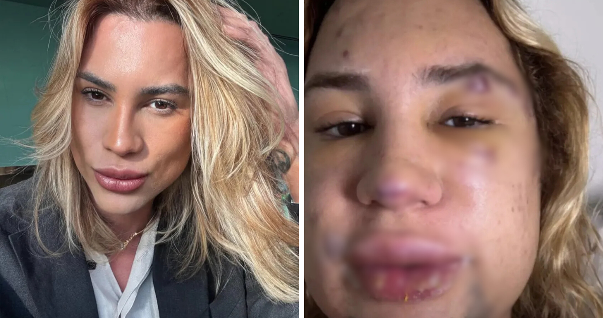 Joven influencer falleció tras someterse a viral cirugía “fox eyes” en Brasil.