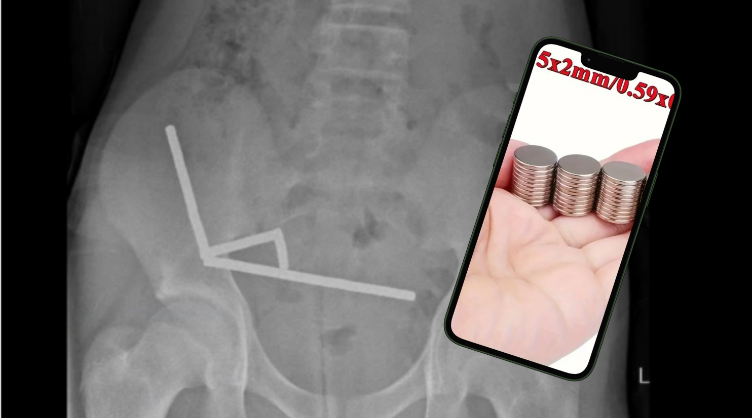 Exitrpan parte de sus intestinos a niños que se tragó 100 imanes de alta potencia comprados en Temu