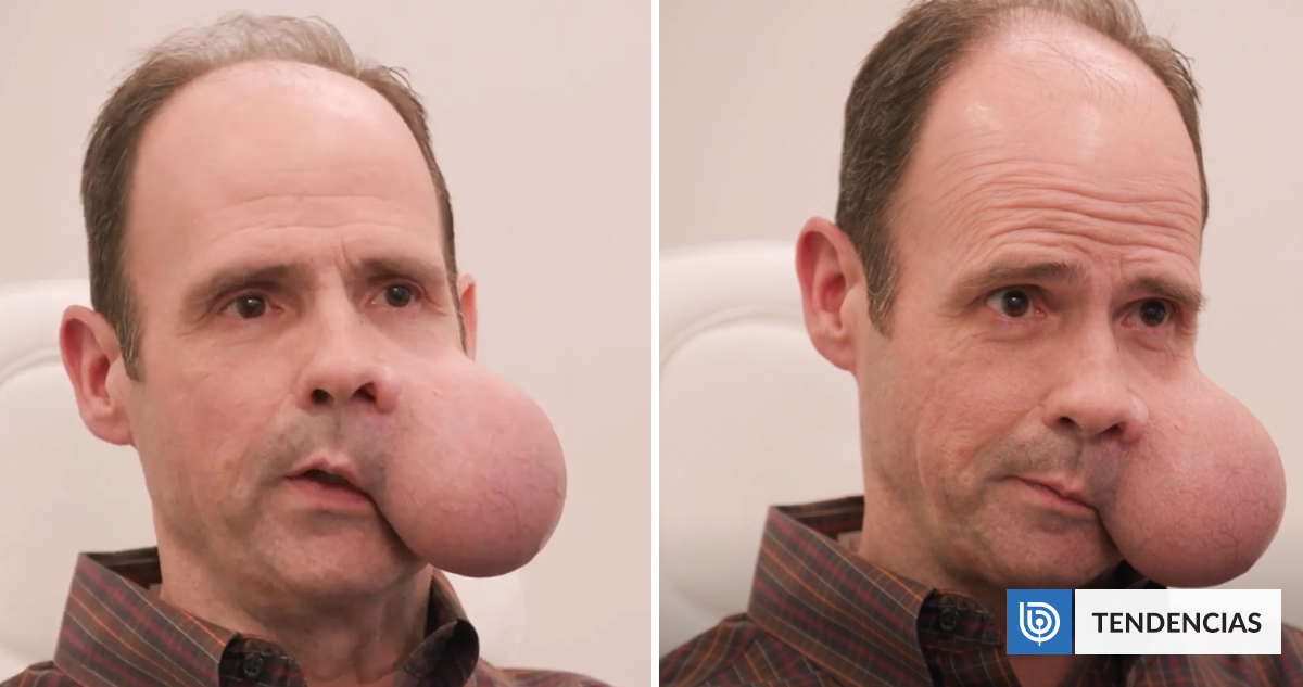 Develan caso de hombre que vive con tumor de 2 kilos en su cara en EEUU: "Es una sentencia de muerte"