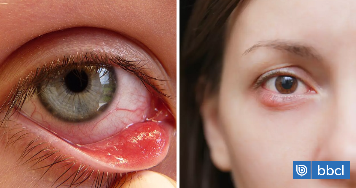 Por qué salen los orzuelos y por qué el anillo de oro o “reventarlos” no sirven para curarlos