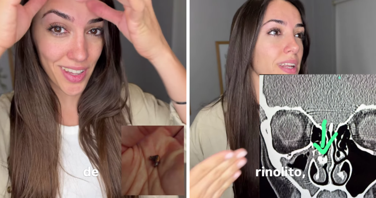 Argentina descubre objeto atascado en su nariz por más de 20 años