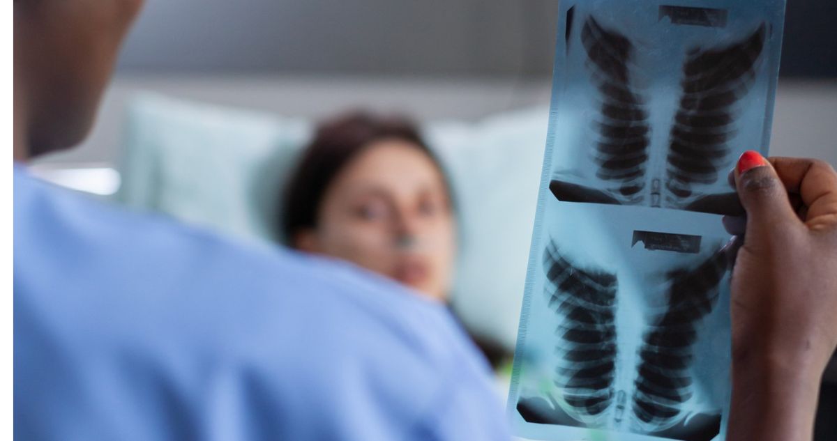 Viral: Chilena afirma que se quebró una costilla por toser mucho, ¿es posible?