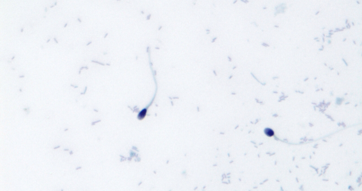 La IA logró el primer embarazo en caso de infertilidad masculina