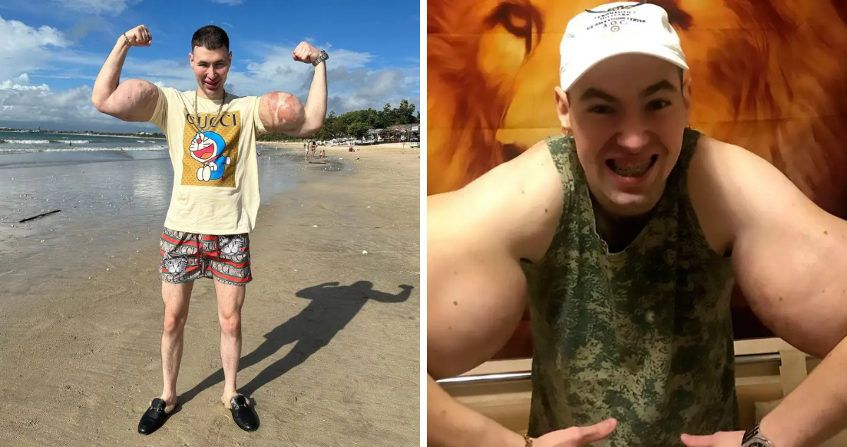 joven se inyectó vaselina en los bíceps y ahora podría perder sus brazos por infección