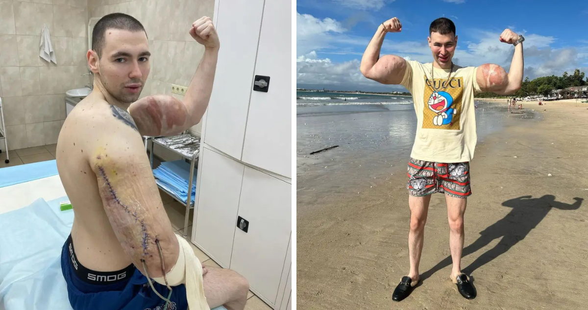 Se inyectó vaselina en los bíceps y ahora podría perder sus brazos por infección 