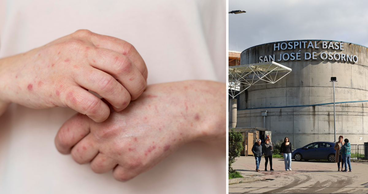 Confirman brote de varicela en establecimiento educacional de Osorno: dos estudiantes hospitalizados