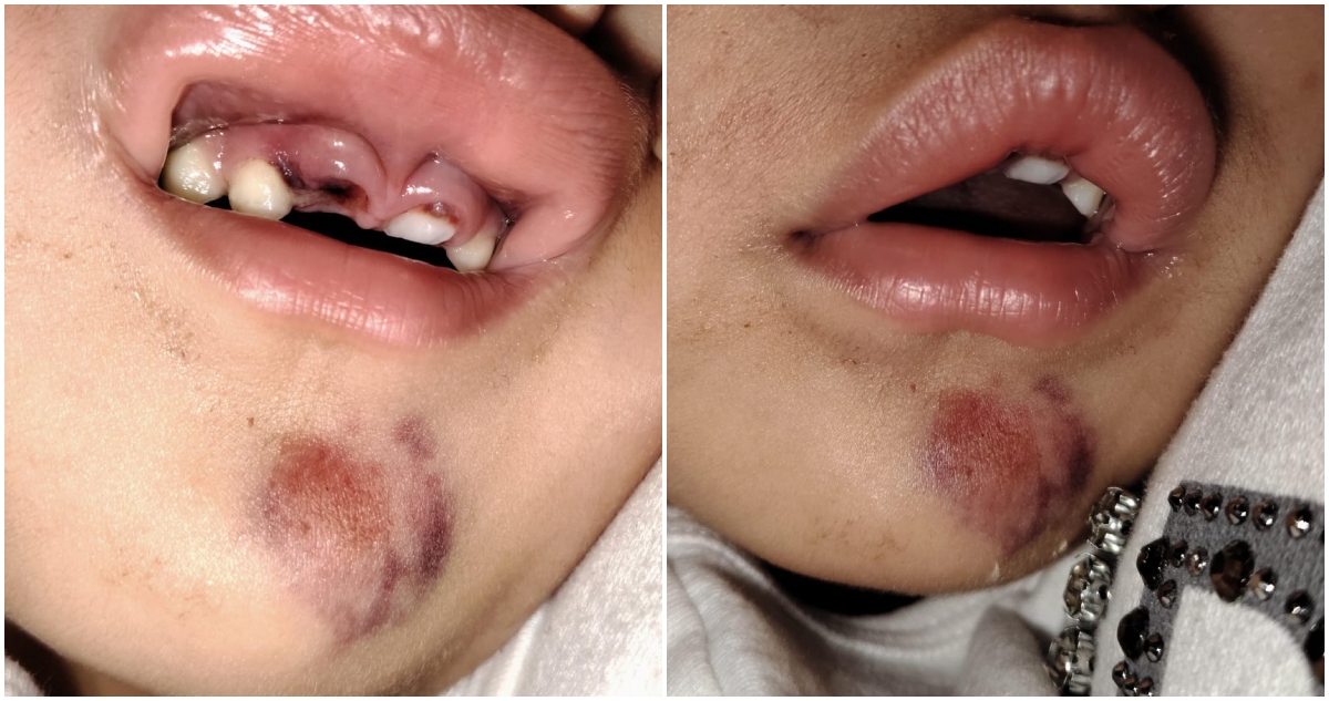 demanda por caída de niña desde juego infantil