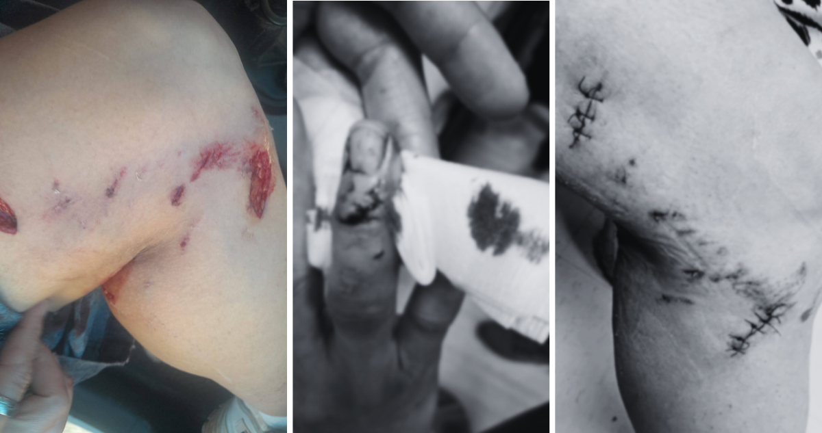 Funcionaria del Cementerio de Lota permanece internada tras grave ataque de perro dentro del recinto