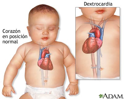 Ilustración de la dextrocardia