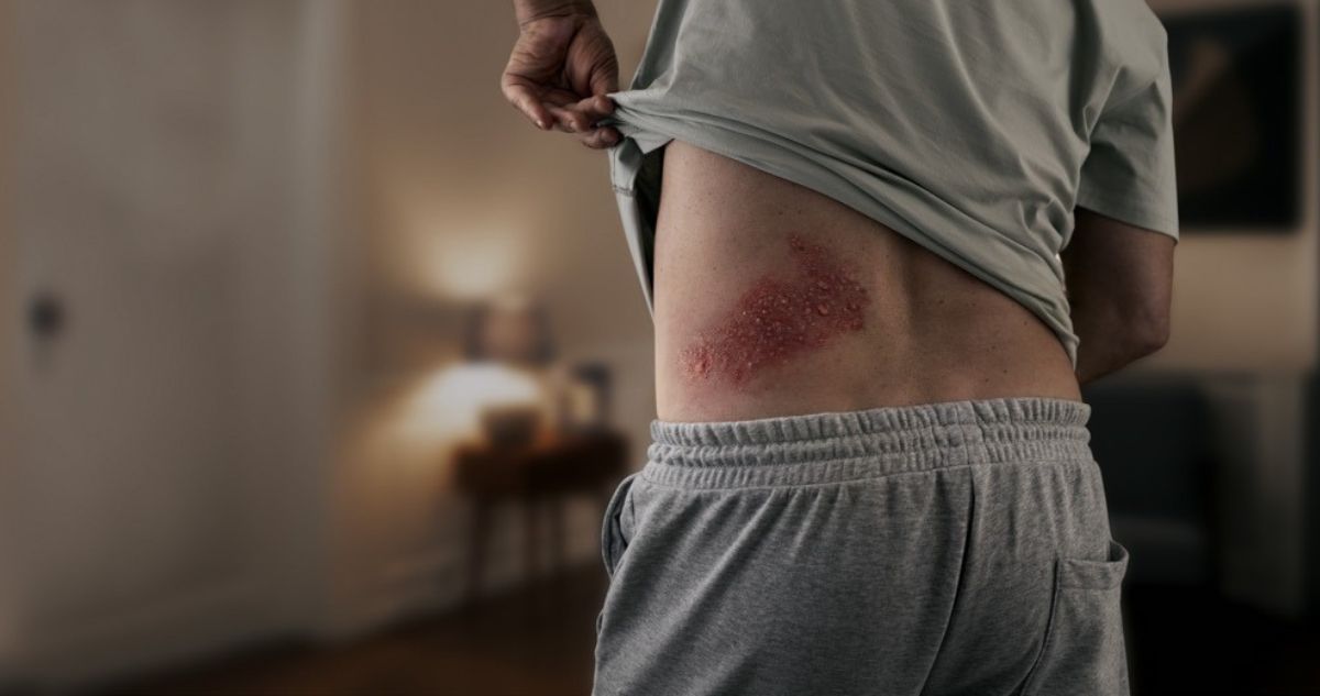 Los silenciosos peligros del herpes zóster: 95% de los adultos están en riesgo de tenerlos