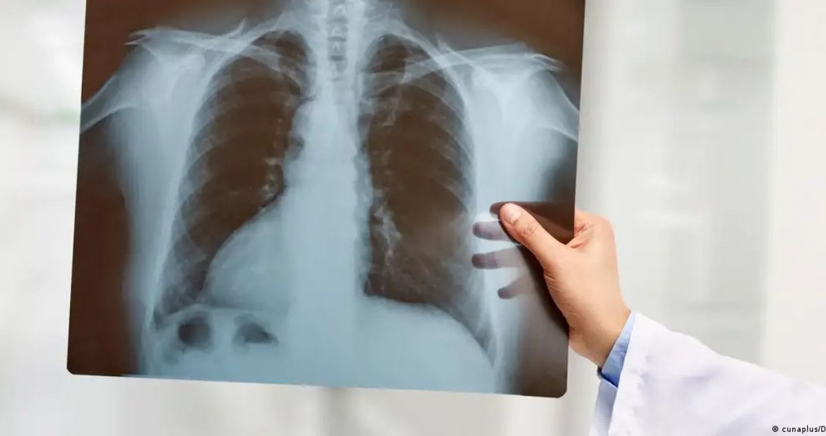 Médicos logran mantener con vida a un hombre sin pulmones por 48 horas: ¿cómo lo hicieron?