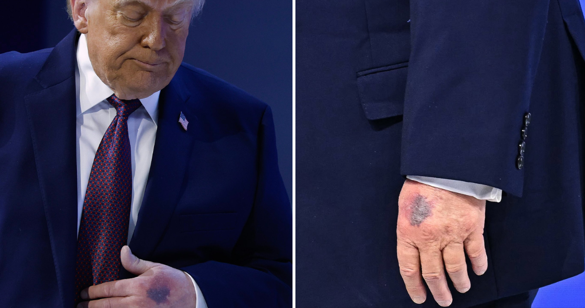 Moretones en mano de Trump