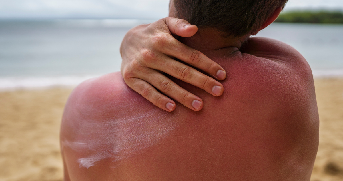 Los errores más comunes al aplicarse bloqueador: se espera alta radiación solar este fin de semana