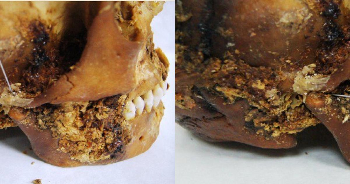 Encuentran un cráneo que tenía una cirugía maxilofacial de hace 2.500 años