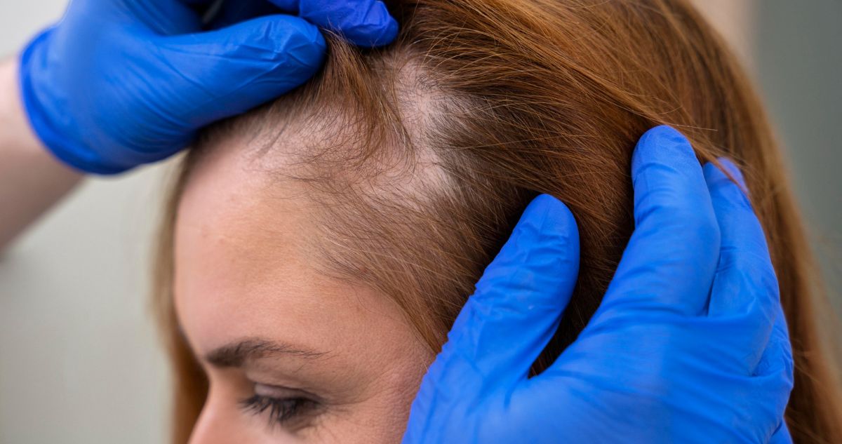 Aumentan las consultas efluvio telógeno, causa de caída del cabello en mujeres: cuáles son las causas