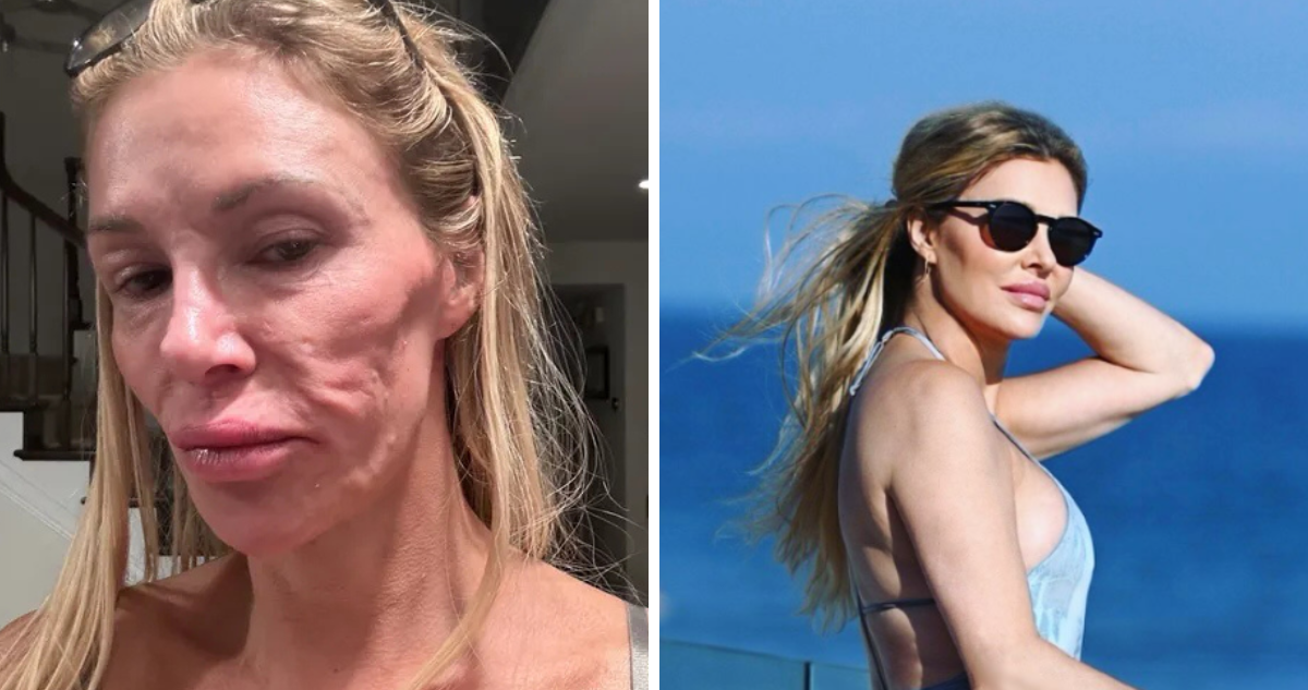 Exmodelo estadounidense dice que su “parásito” facial fue causado por fallas en sus implantes mamarios