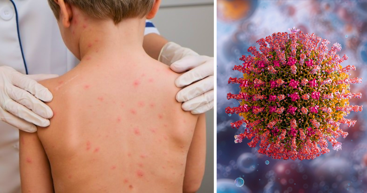 Minsal confirma caso importado de sarampión en un lactante: estuvo recientemente en México