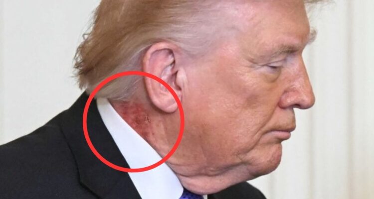 Qué pudo causar el sarpullido de Donald Trump: médico del presidente confirmó tratamiento
