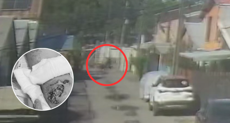 VIDEO | Debió recibir injerto de piel: mujer fue atacada por jauría de perros en San Pedro de la Paz