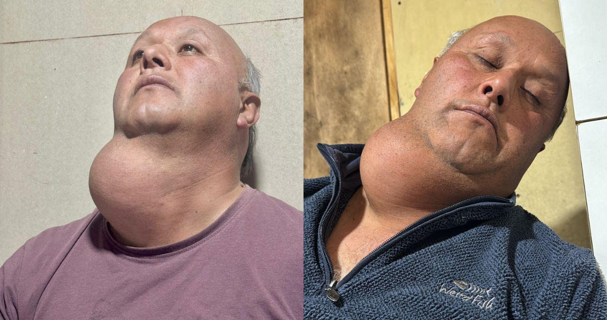 Casi 17 años esperando una operación: el calvario de carpintero que vive con enorme bulto en su cuello