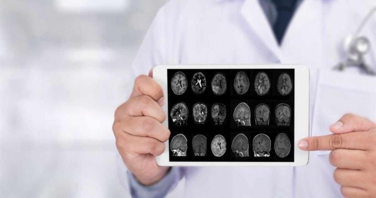 Descubren enfermedades que podrían predecir el Alzheimer hasta 10 años antes de los síntomas