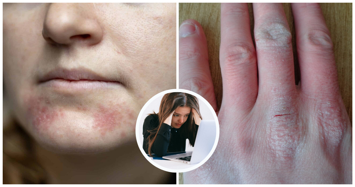 El estrés puede empeorar afecciones de la piel como la dermatitis atópica