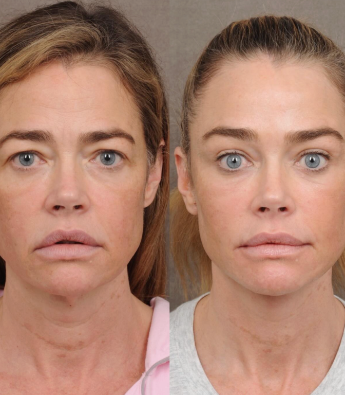 ¿Qué se hizo en el rostro Denise Richards? El antes y después de la ex chica Bond