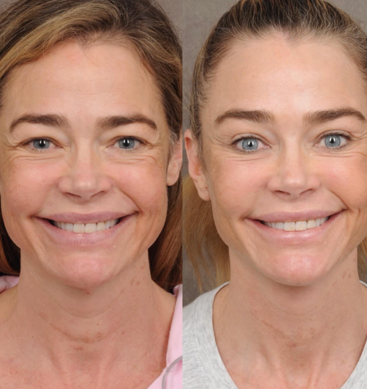 ¿Qué se hizo en el rostro Denise Richards? El antes y después de la ex chica Bond