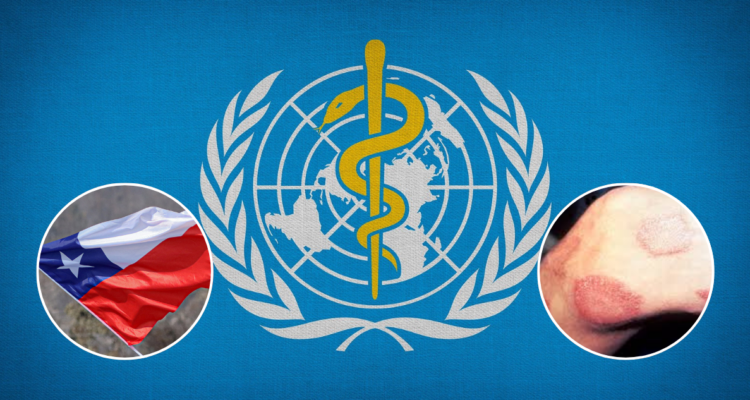 OMS reconoce a Chile como segundo país en erradicar la lepra: no han existido casos en más de 30 años