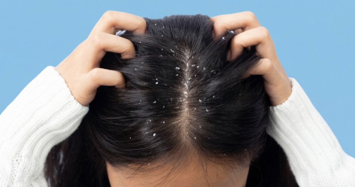 Más que estética: Ducray lanza en Chile champú intensivo contra la caspa y cuidado del cuero cabelludo