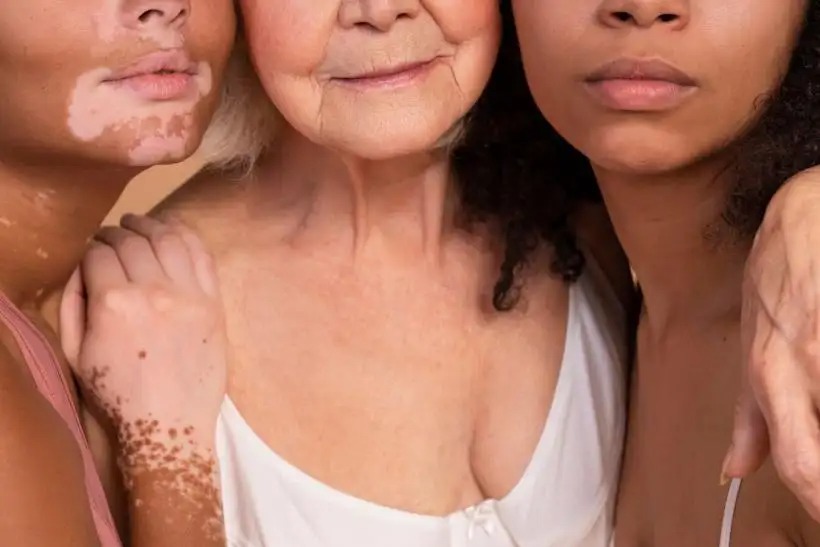 Todo lo que se sabe del vitiligo: el caso de Michael Jackson y el tratamiento que usó para ocultarlo