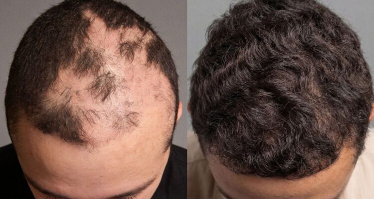 Más que una cicatriz: cómo un implante capilar gratuito cambia para siempre la vida de niños quemados