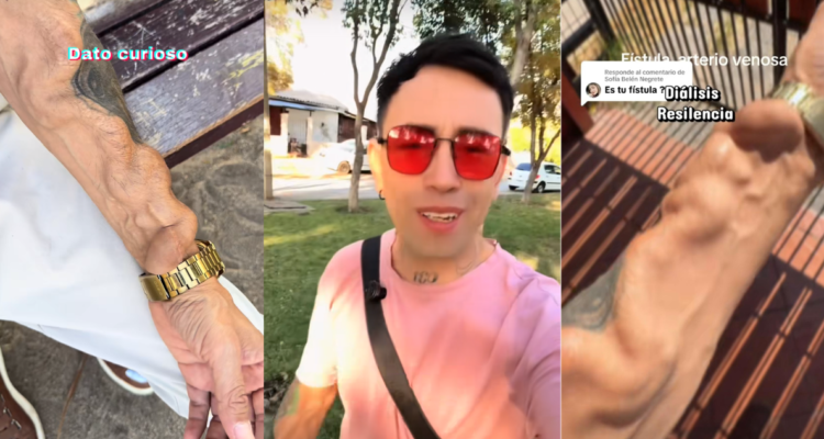 Joven chileno relató calvario tras muela infectada: terminó con trasplante renal