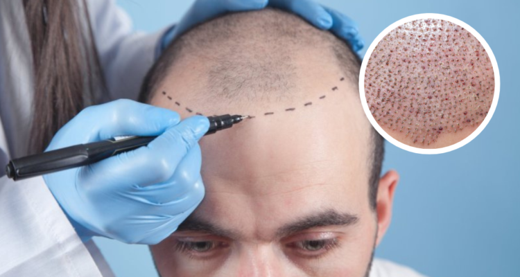 En qué consisten los trasplantes de pelo que son furor en las redes sociales