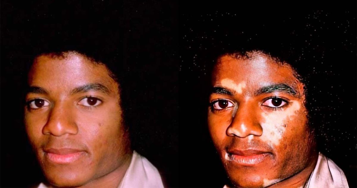 Todo lo que se sabe del vitiligo: el caso de Michael Jackson y el tratamiento que usó para ocultarlo