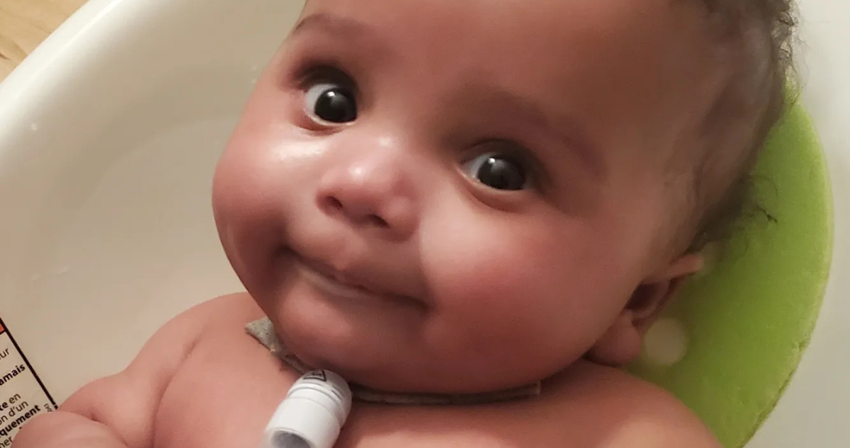Bebé con grave trastorno congénito nació dos veces tras innovadora cirugía