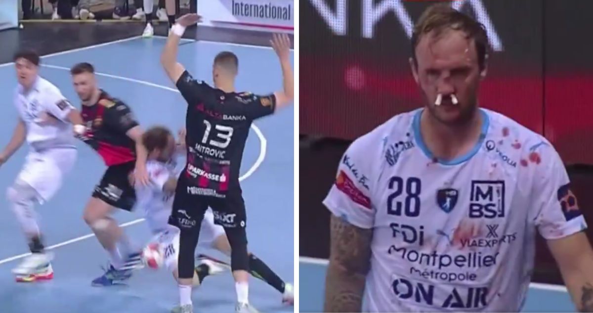 La infracción que estremece al handball europeo: francés terminó con la nariz fracturada tras manotazo